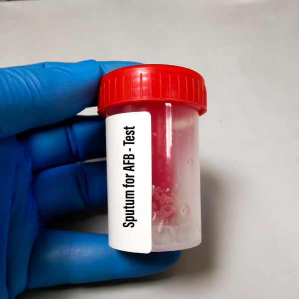 Sputum M/C/S