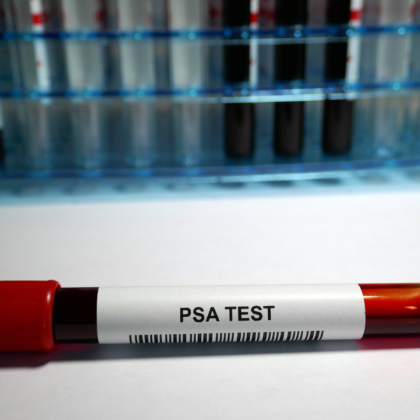 Prostate Specific Antigen (PSA)