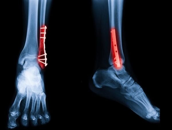Tibia/Fibula Both