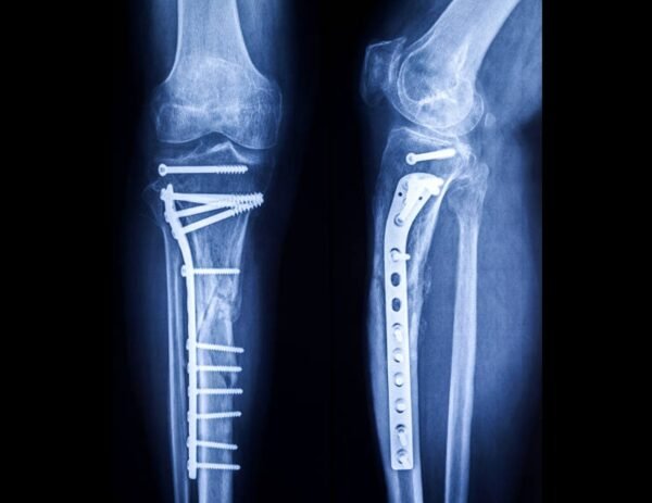 Tibia/Fibula (Leg) Single