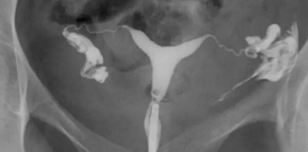 Hysterosalpingography (HSG)