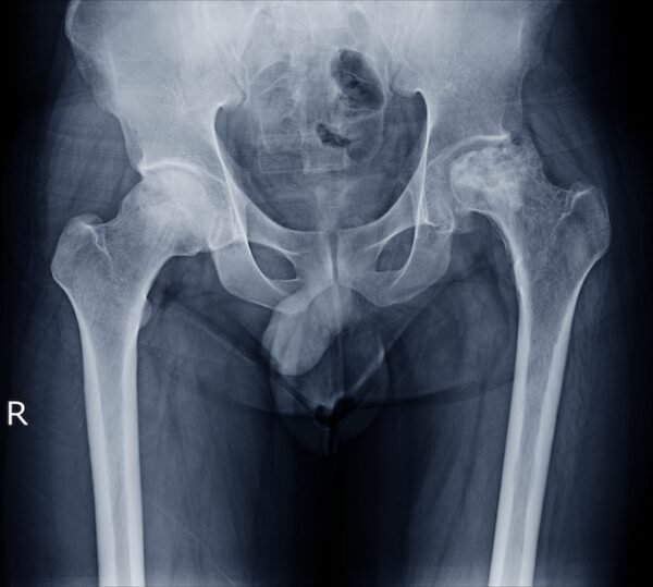 Femur Both