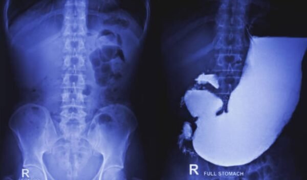 Barium Meal and Follow Through