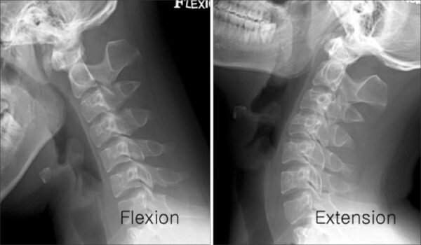 Cervical Spine Dynamic (Flexion and Extension)